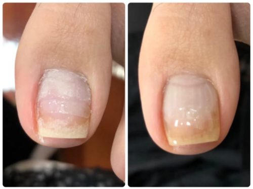 06-3　巻爪矯正　育成前・結果